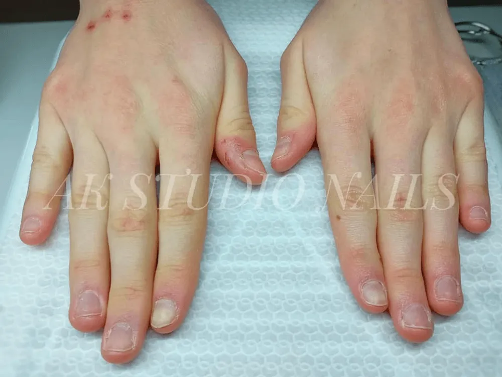 Przed: Efekt specjalistycznej terapii stóp