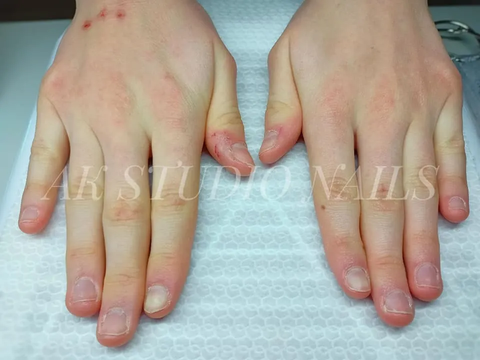 Efekt terapii podologicznej