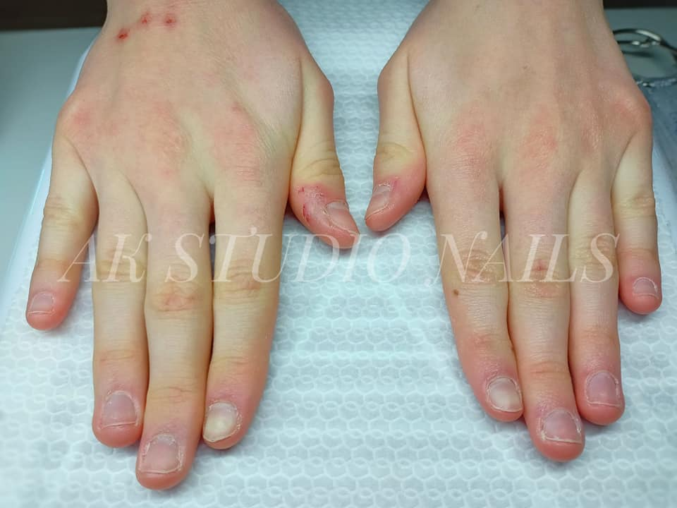 Przed zabiegiem podologicznym